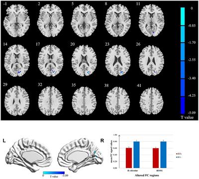 Decreased Functional Connectivity of the Primary Visual Cortex and the Correlation With Clinical Features in Patients With Intermittent Exotropia